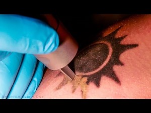 How laser tattoo removal works