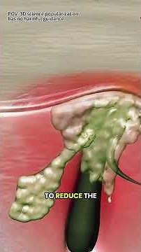 Ingrown Hairs Explained 🇱🇷 3D Medical Animation on Causes, Treatment & Prevention
