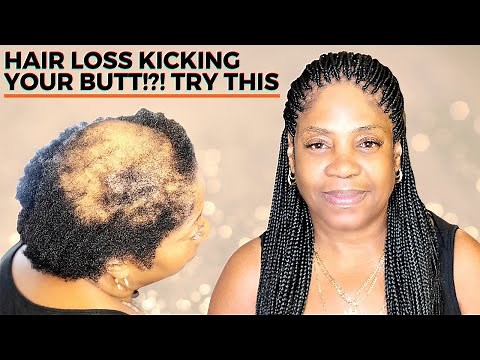 HOW TO BOX BRAID FOR BEGINNERS (ALOPECIA VERSION)