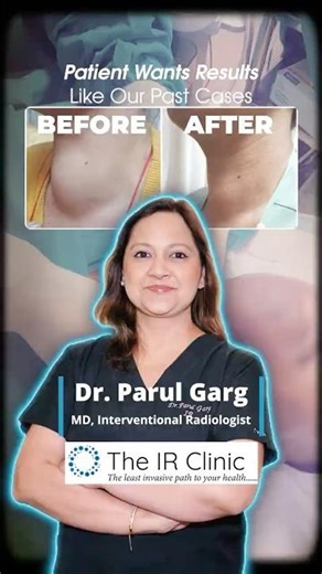 Another Thyroid Nodule Ablation Case ✅ Real Before/After Journey | Dr. Parul Garg