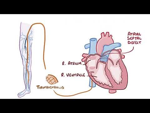 Pulmonary Embolisms causes, symptoms, diagnosis, treatment, pathology