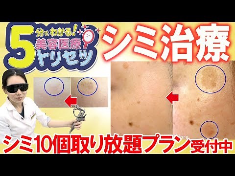 【5分でわかる！美容医療のトリセツ】シミ取りレーザーで取れる3種類のシミ【湘南美容クリニック】