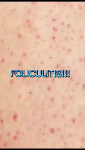 Foliculitis: Causas, Tratamientos y Prevención