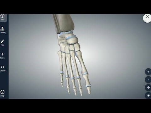 Multiple Metatarsal Fracture