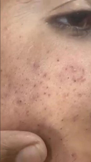 Sac be spa nose blackhead clean with #spafacial #asmr #665724 #nosestrips #relaxer #nose