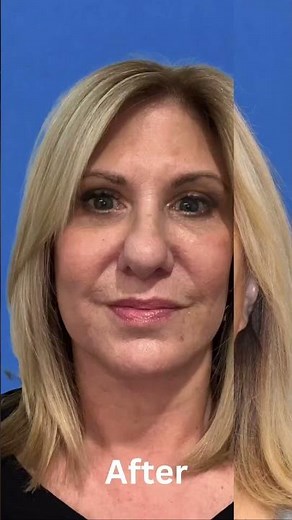 Dr. Amir Karam's INCREDIBLE Vertical Restore Facelift Transformations!