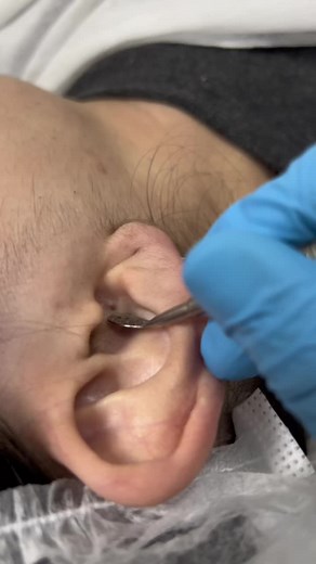 Professional Ear Cleaning: Step-by-Step Procedure