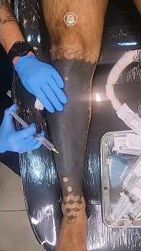 Remoção satisfatória de tatuagem blackout | Remoção de Tatuagem