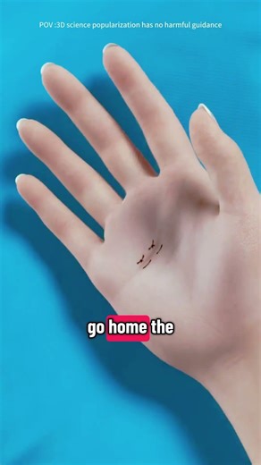 How Trigger Finger Release Surgery Is Done (3D Animation)#medical3danimation#triggerfinger