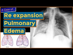 Re-Expansion Pulmonary Edema