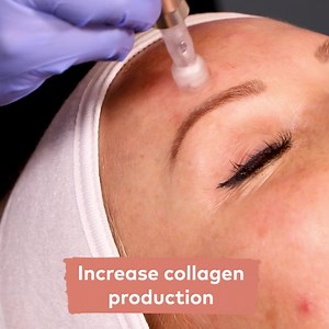 We are so excited to introduce you to our NEW Exceed Microneedling treatment! ⁠ ⁠ Microneedling with our Exceed medical device at Caci is FDA approved and clinically proven to:⁠ 🧬 Increase collagen⁠ 👋🏼 Reduce appearance of pigmentation⁠ 🌟 Improve skin texture and tone⁠ 🌈 Reduce appearance of fine lines⁠ 😳 Bid farewell to acne scarring⁠ ⁠ Here is what some of our Caci lovers had to say about this new Microneedling treatment:⁠ “I have just experienced our new Microneedling device, no numbing