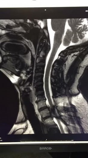 Dynamic MRI with Valsalva maneuver