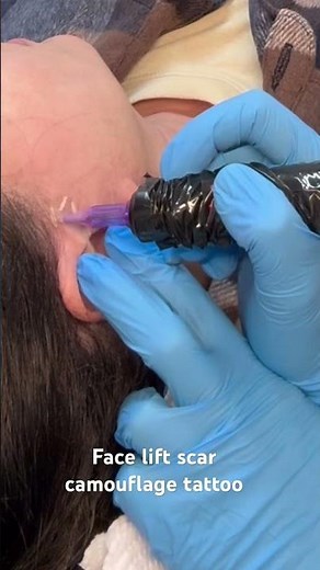 Scar camouflage tattooing facelift scars