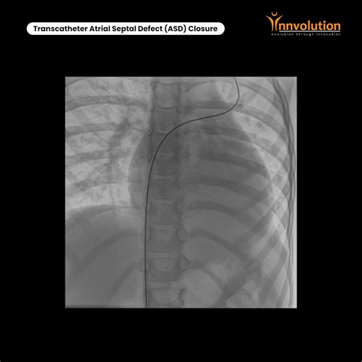 Innvolution | Transcatheter Atrial Septal Defect (ASD) Closure: A pediatric patient with a congenital Atrial Septal Defect (ASD) underwent Transcatheter... | Instagram