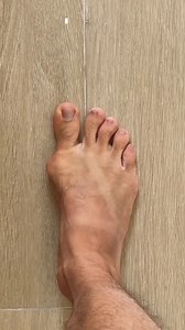 Bunions don’t have to control your movement—fix the cause, strengthen your feet, wear the right support, and stay consistent for pain-free steps 👣💪