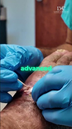 Advanced Venous Ulcer Treatment & Circulation Care | Laser Vascular Center!