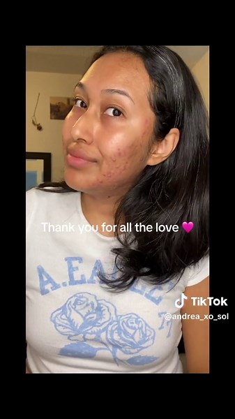 I got scared at the end 🙅🏻‍♀️🙅🏻‍♀️🙅🏻‍♀️ my pimples are so dry from the trentnoin cream thats why the last one was hard to get out. #juicy