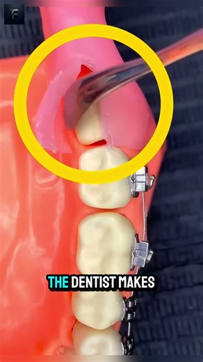 the reasons a dentist needs to perform gum surgery