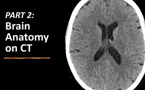 How to read a brain CT (part 2)_ Brain anatomy on CT