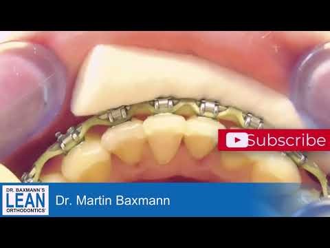 Teach your staff fixed retainers