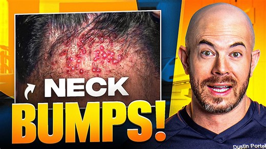 Doctor Identifies Rare Scalp Condition Behind Patient's Persistent Bumps: Acne Keloidalis Nuchae