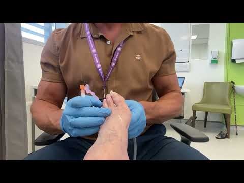 Double Morton’s neuroma injection by ultrasound guidance