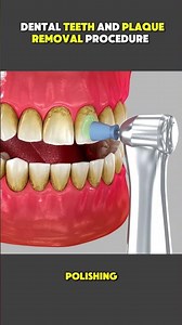 Before & After Dental Cleaning 😍 | Deep Plaque Removal & Polishing #teethcleaning