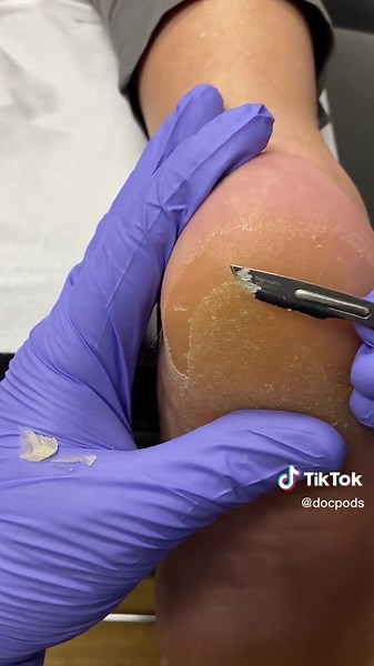 Professional Callus Removal by Australian Podiatrist