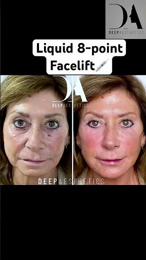 Liquid 8 Point Facelift 🪄