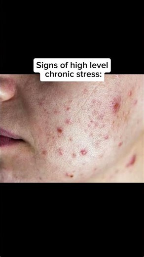 Chronic stress influences the skin (acne,#stress #mentalhealth #dryskin #psoriasis #eczema #acne