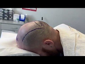 Skull Reshaping Before and After!