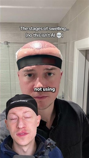 INSANE Swelling After A Hair Transplant | Hair Surgeon Reacts