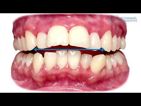 Over-Bite vs Over-Jet Differences