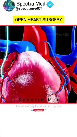 Angioplasty Explained: How This Life-Saving Heart Procedure Restores Blood Flow Instantly #biology
