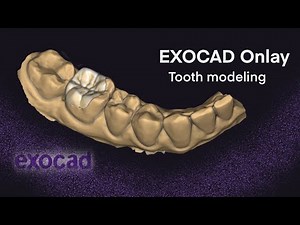 Exocad Onlay I Tooth modeling 3