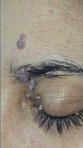 massive wart removal