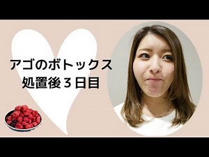 【プチ整形】アゴのボトックス注射後３日目の経過【最後にお得情報あり】【田町・品川】【医療脱毛・美容皮膚科・AGA】