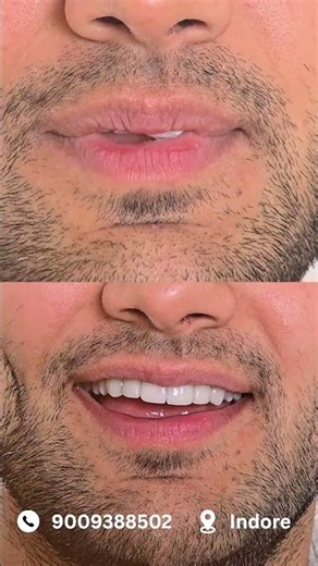 Smile Correction 😍 Veneers Before After #smiledesigndental