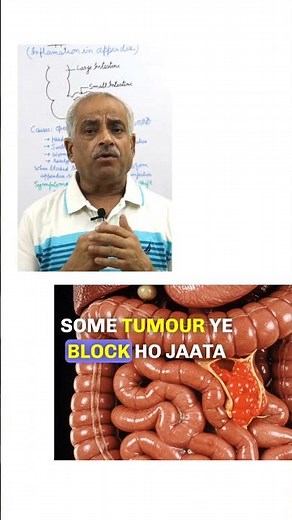 APPENDICITIS - What it is and how to identify it