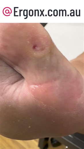 Podiatrist Removes Big Toe Corn & Callus Satisfying Treatment #Podiatry #FootCare