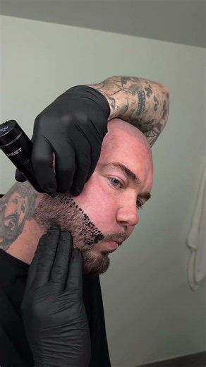 scalp micro pigmentation !!!!