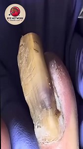 Trusted advice to care for discolored nails needing extra care 😍 #SimpleHealthTricks #DiabeticFootCare #HealthyHabits | Bye