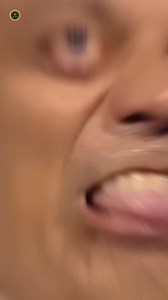 13K views · 71 reactions | Eye bulging #reelusa #factsvideo #viralfact #science #facts #reel #crazyfactor #medicalfact #eyebulging #thyroid | Crazy factor | Facebook