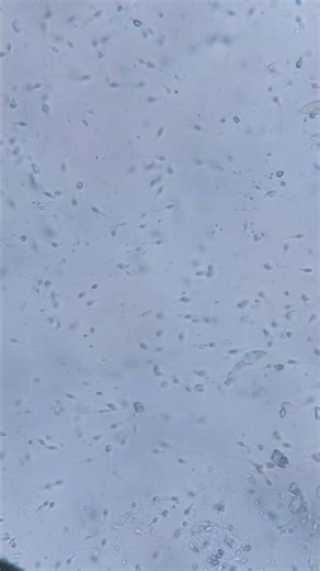 Seman analysis | sperm Agglutination |sperm undermicroscope |Sperm count | malefertility test #dmlt