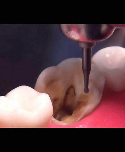 Root canal full procedure 🦷 #dr_hammad_official #unfreezemyacount #fypシ゚viral #dentistry #100kviews #standwithkashmir #newtrend #1millionaudition