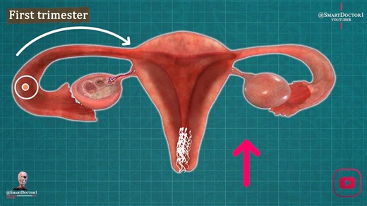 Smart Doctor on Instagram: "First Trimester of Pregnancy| week-by-week 👼🏻🤰🏻 . . . . . . 1. First Trimester (Weeks 1 to 12) Fertilization: Occurs when a sperm fertilizes an egg, forming a zygote. Embryo Development: The zygote divides and develops into an embryo. By the end of this stage, most major organs are formed. Common Symptoms: Include nausea (often called morning sickness), fatigue, and breast changes due to hormonal shifts. . . #womb #birth #delivery #birthday #pregnancy #pregnant #b