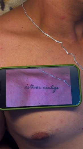 Para quem tem dúvidas de como fica a remoção.. sem cicatrizes e danos. #remocaodetatuagem #tatuagem #foryou #duvidas