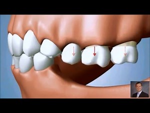Drifting Teeth and Over Eruption of Teeth