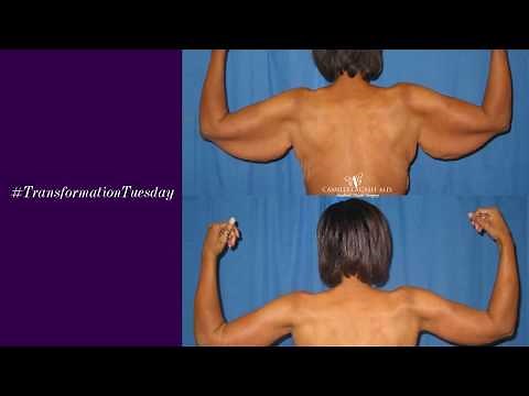Brachioplasty (Arm Lift) Surgery at Camille Cash M.D. in Houston