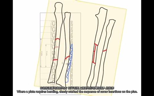 《骨折治疗的AO原则》术前计划步骤动画演示(中英字幕)